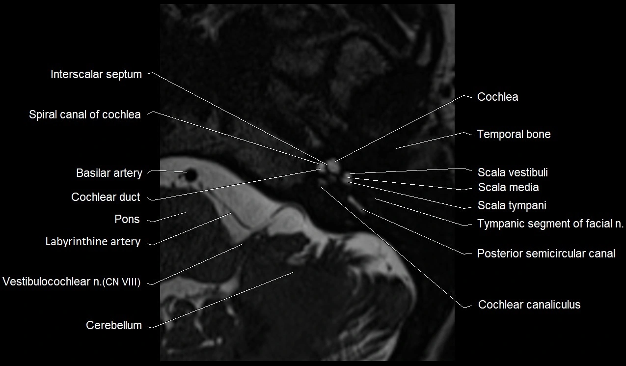 Internal auditory canal (IAC) axial cross sectional anatomy image 7.webp